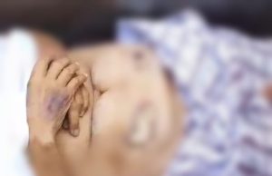 Misteri Kematian Pasien Usai Operasi di RS Hastin Karawang, Keluarga Temukan Kasa di Dalam Perut Usai Operasi, Pasien Temukan Luka Misterius dan Cairan Hitam dari Perut. (AlexaPodcast.ID)