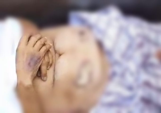 Misteri Kematian Pasien Usai Operasi di RS Hastin Karawang, Keluarga Temukan Kasa di Dalam Perut Usai Operasi, Pasien Temukan Luka Misterius dan Cairan Hitam dari Perut. (AlexaPodcast.ID)
